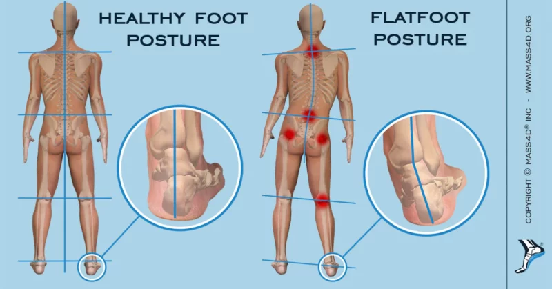 Can Flat Feet Cause Back Problems?