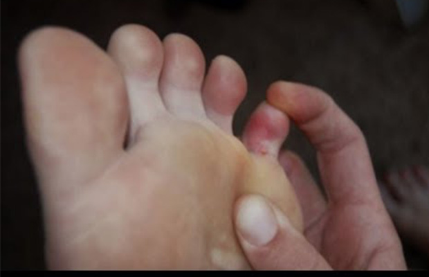 Pinky Toe Hurt