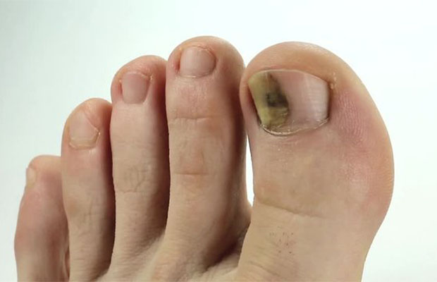 Bruised Toenail