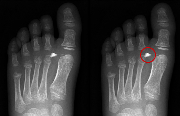 Foot X Rays