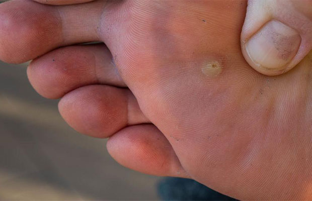 Plantar Wart