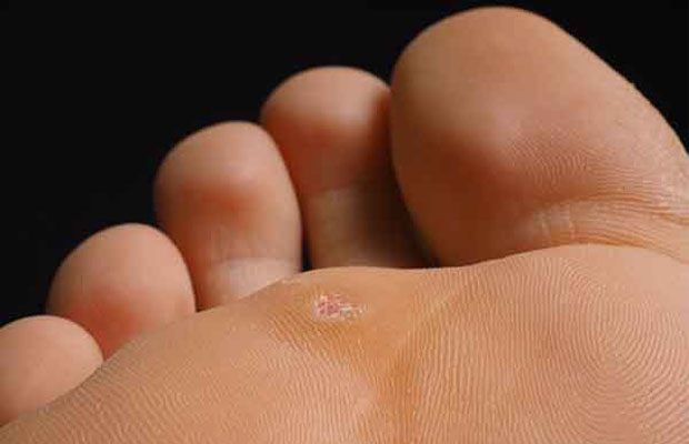 Plantar Wart