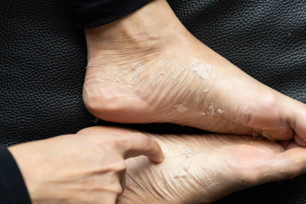 How To Remove Dead Skin From Feet? How To Prevent?