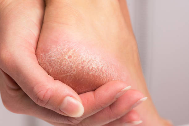 How To Remove Dead Skin From Feet? How To Prevent?