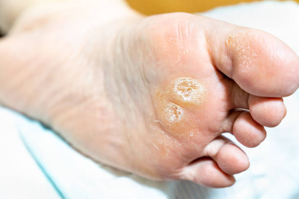 How To Prevent Calluses On Feet? (6 Effective Tips)