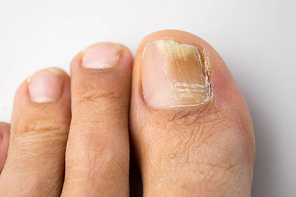 What Causes Toenails To Fall Off? And What To Do?
