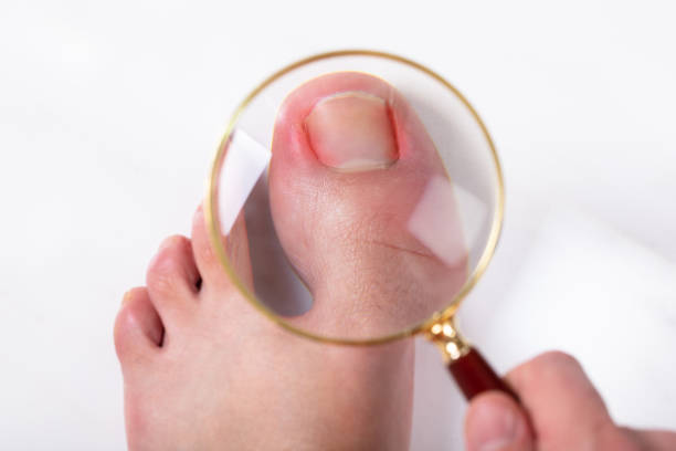 What Causes Toenails To Fall Off? And What To Do?